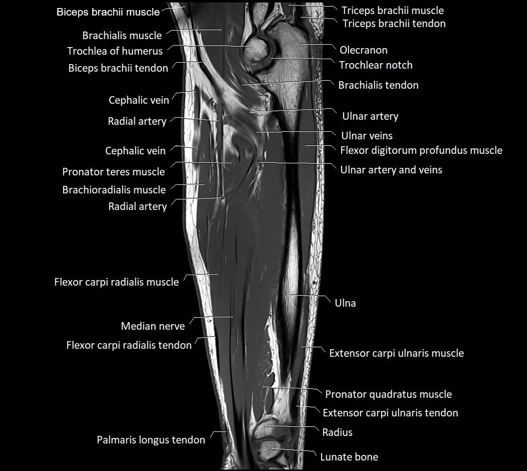 MRI 3T forearm sagittal labelled cross sectional anatomy image 23.webp